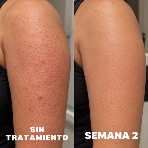 Fresia™ | Crema Triple Ácido para piel de fresa