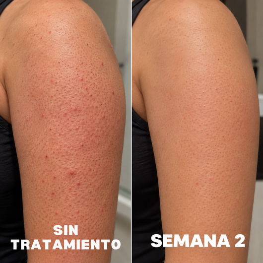 Antes y después: sin tratamiento vs semana 2