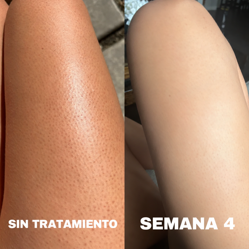 Fresia™ | Crema Triple Ácido para piel de fresa