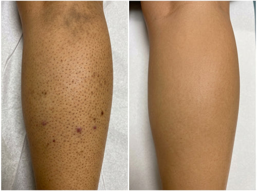 Fresia™ | Crema Triple Ácido para piel de fresa