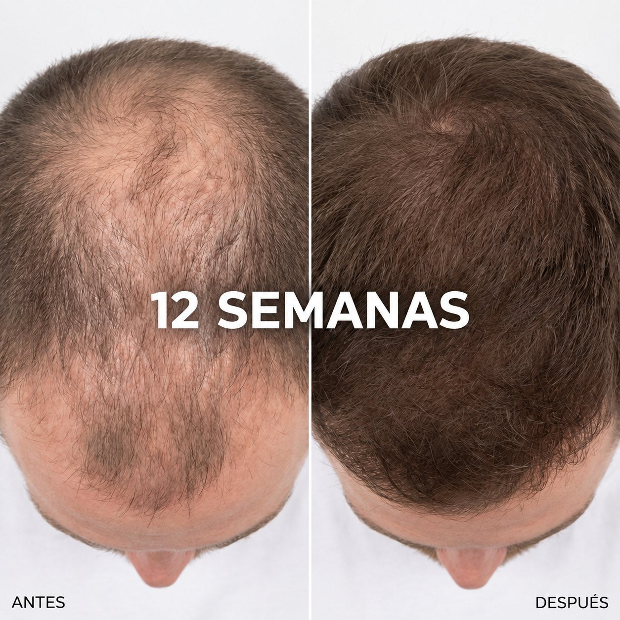 Resultados de crecimiento capilar en hombres: antes y después a las 12 semanas