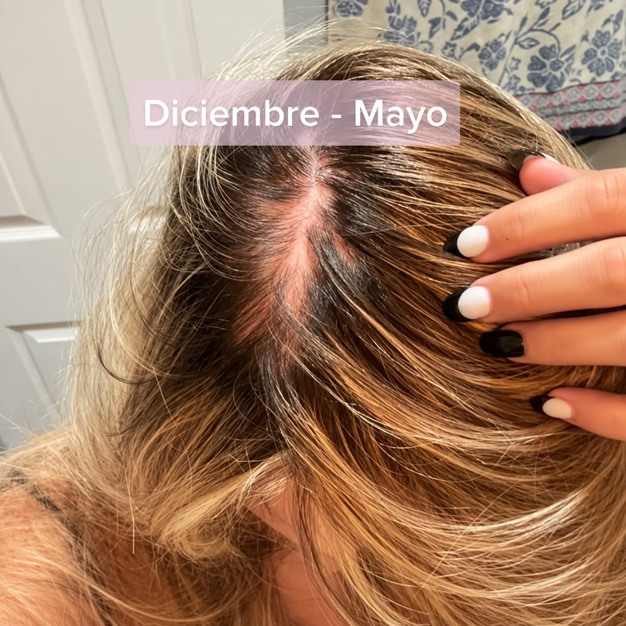 Estadísticas: 50% de las mujeres experimenta pérdida de cabello