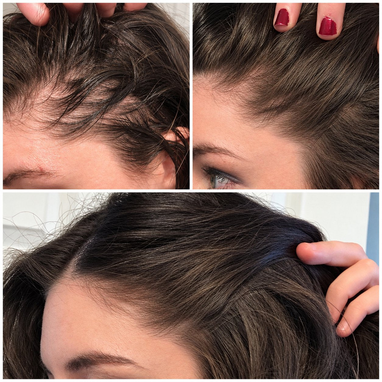 Dos caminos: seguir con minoxidil o cambiar a RomeRoll™